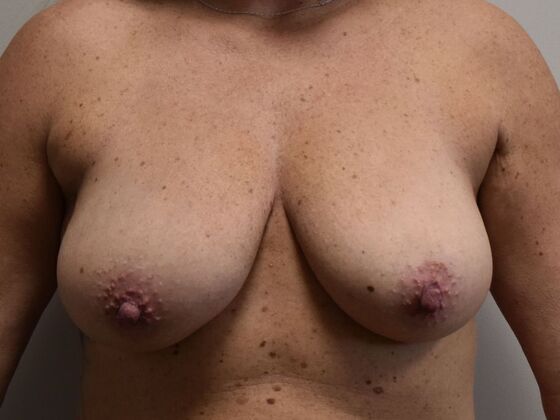 Breast Lift (Mastopexy) Case 242 - Before