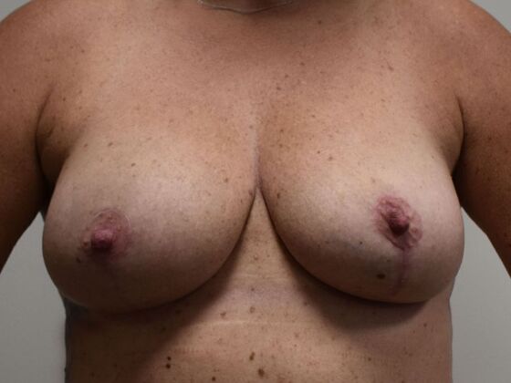 Breast Lift (Mastopexy) Case 242 - After