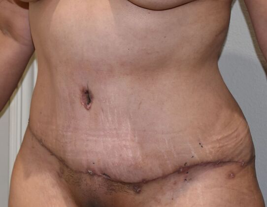 Tummy Tuck (Abdominoplasty): Case 536 - After