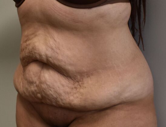 Tummy Tuck (Abdominoplasty): Case 536 - Before