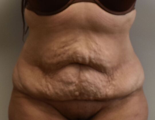 Tummy Tuck (Abdominoplasty) Case 536 - Before