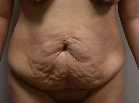 Tummy Tuck (Abdominoplasty) Case 537 - Before