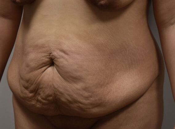 Tummy Tuck (Abdominoplasty): Case 537 - Before