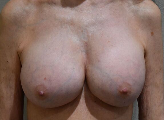 Breast Implant Removal: Case 55 - Before