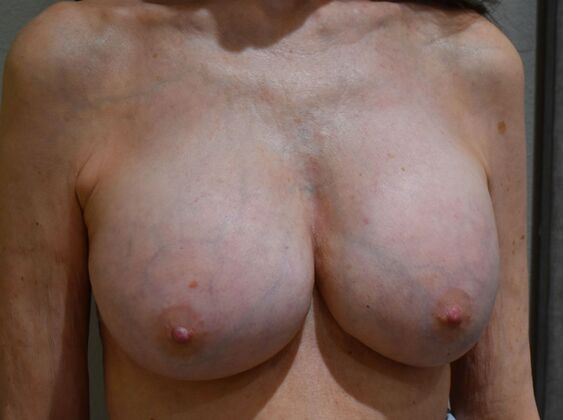 Breast Implant Removal: Case 55 - Before
