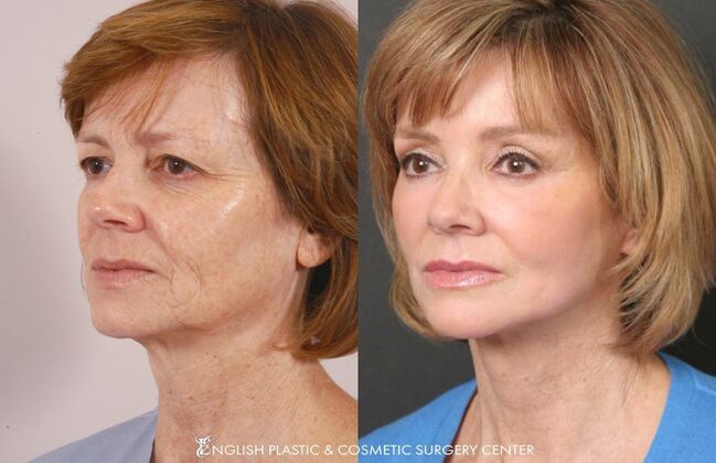 Lip Augmentation: Case 1 - Before & After