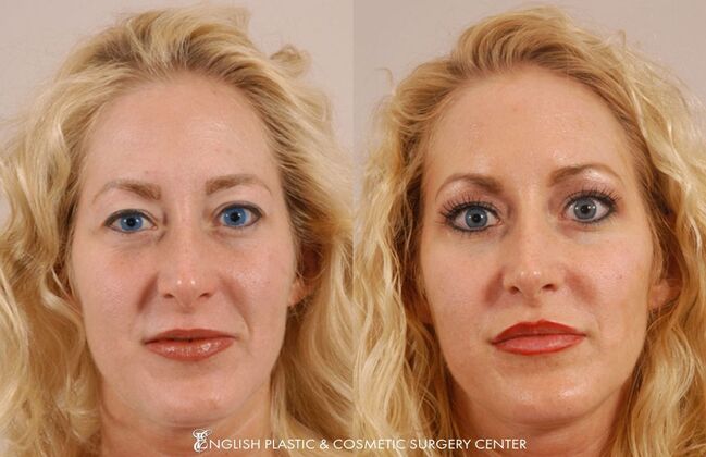 Lip Augmentation: Case 2 - Before & After