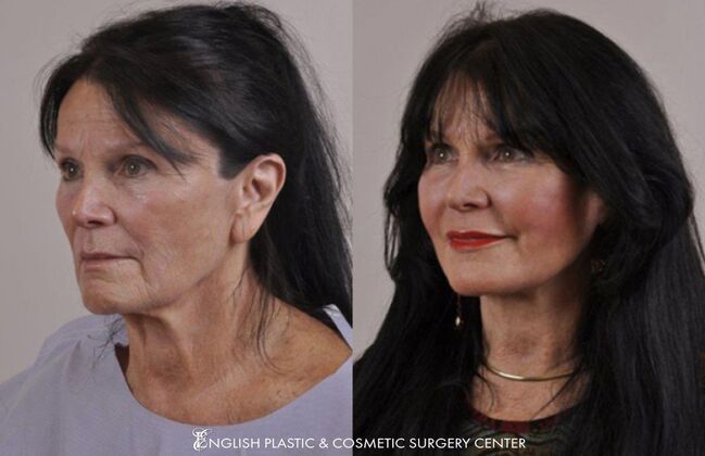 Lip Augmentation: Case 3 - Before & After