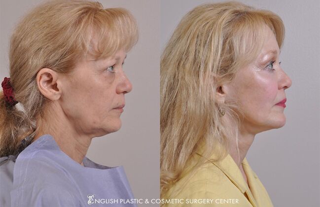 Cheek Augmentation/Implants: Case 1 - Before & After