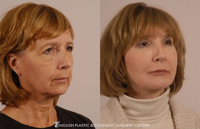 Cheek Augmentation/Implants: Case 2 - Before & After