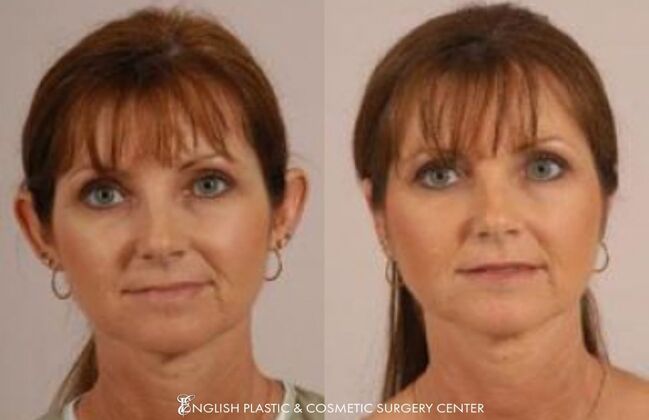 Ear Surgery (Otoplasty): Case 2 - Before & After