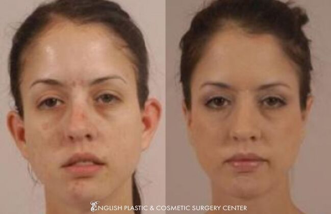 Ear Surgery (Otoplasty): Case 3 - Before & After