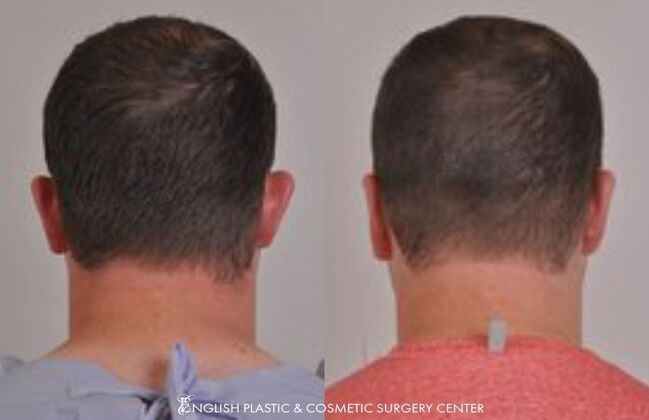 Ear Surgery (Otoplasty): Case 4 - Before & After