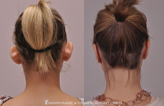 Ear Surgery (Otoplasty): Case 10 - Before & After