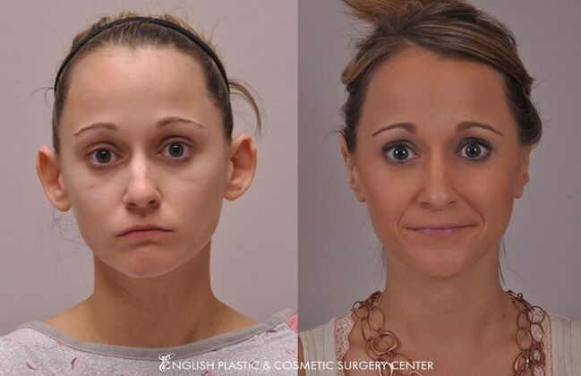 Ear Surgery (Otoplasty): Case 5 - Before & After