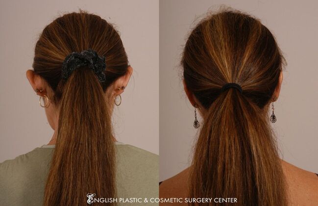 Ear Surgery (Otoplasty): Case 6 - Before & After