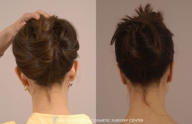 Ear Surgery (Otoplasty): Case 11 - Before & After