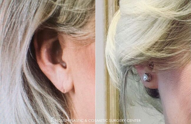 Ear Surgery (Otoplasty): Case 9 - Before & After