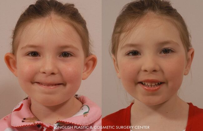 Ear Surgery (Otoplasty): Case 7 - Before & After