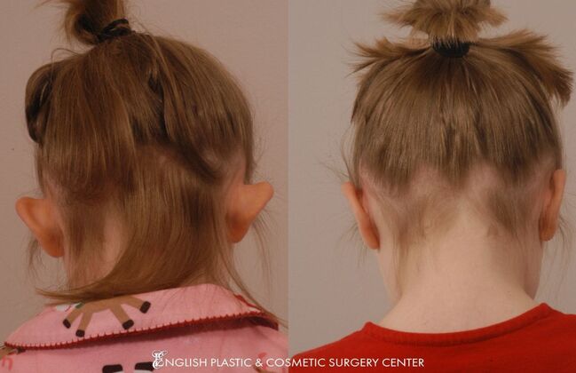 Ear Surgery (Otoplasty): Case 7 - Before & After