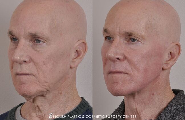 Ear Surgery (Otoplasty): Case 13 - Before & After