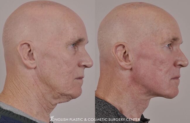 Ear Surgery (Otoplasty): Case 13 - Before & After