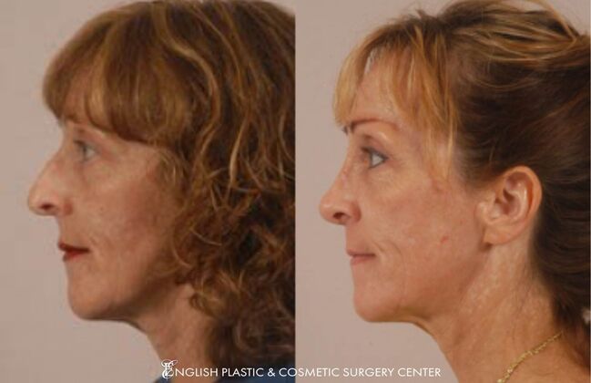 Nose Surgery (Rhinoplasty) Case 26