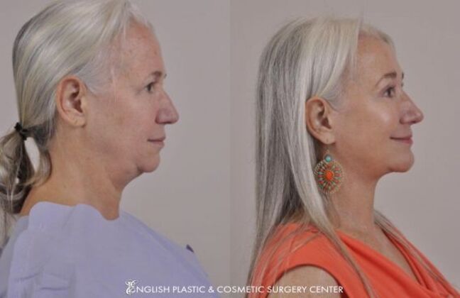 Nose Surgery (Rhinoplasty): Case 21 - Before & After