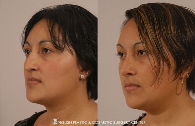 Nose Surgery (Rhinoplasty) Case 24