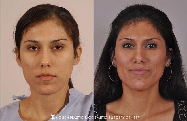 Nose Surgery (Rhinoplasty) Case 14