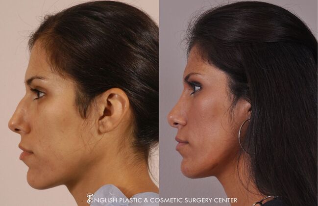 Nose Surgery (Rhinoplasty): Case 14 - Before & After
