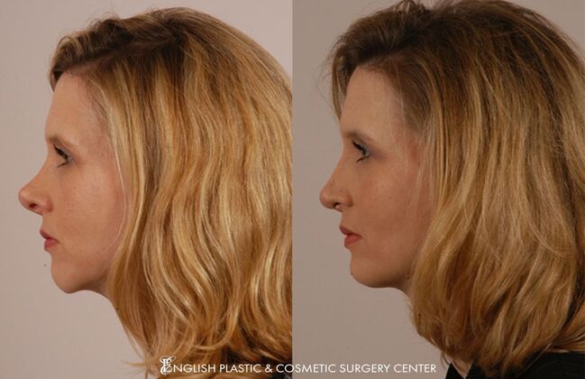 Nose Surgery (Rhinoplasty) Case 22