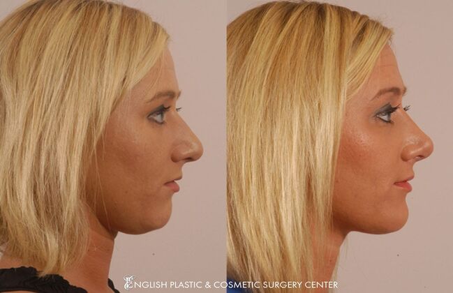 Nose Surgery (Rhinoplasty) Case 20