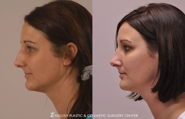 Nose Surgery (Rhinoplasty) Case 18