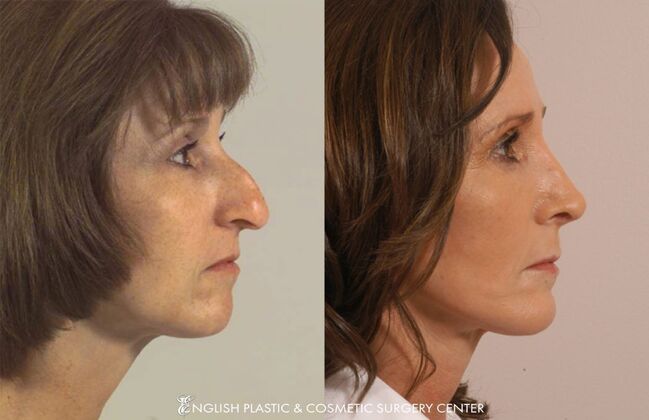 Nose Surgery (Rhinoplasty) Case 17