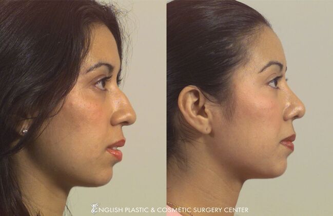 Nose Surgery (Rhinoplasty) Case 15