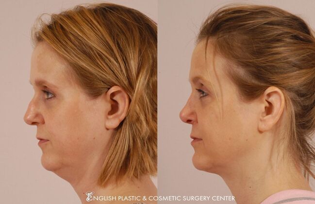 Nose Surgery (Rhinoplasty) Case 16