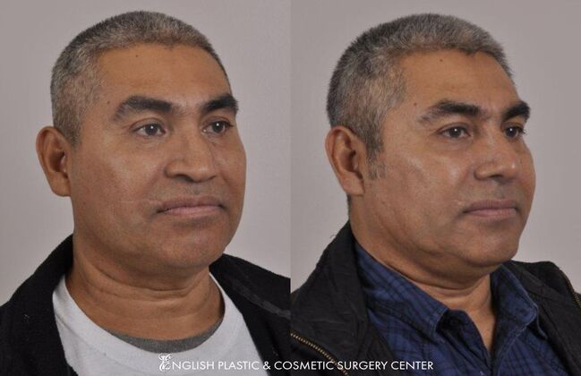 Nose Surgery (Rhinoplasty) Case 11