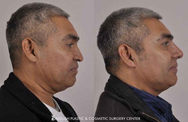 Nose Surgery (Rhinoplasty): Case 11 - After