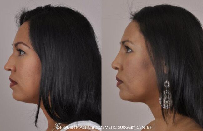 Nose Surgery (Rhinoplasty): Case 9 - Before & After