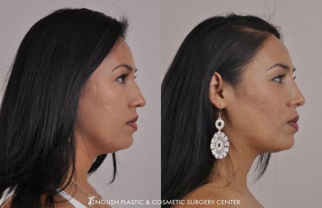 Nose Surgery (Rhinoplasty) Case 9