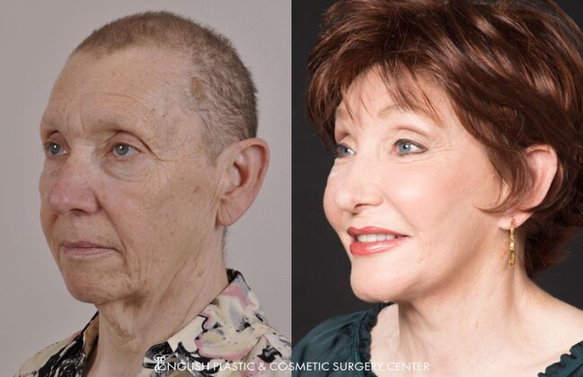 Nose Surgery (Rhinoplasty): Case 1 - Before & After