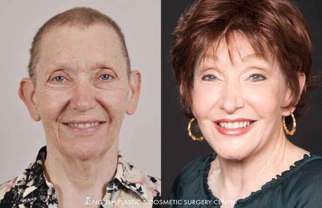 Nose Surgery (Rhinoplasty) Case 1