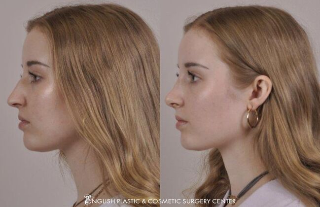 Nose Surgery (Rhinoplasty) Case 10