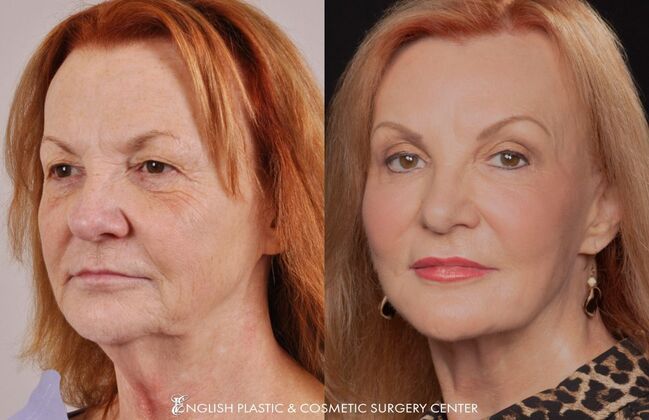 Nose Surgery (Rhinoplasty) Case 6