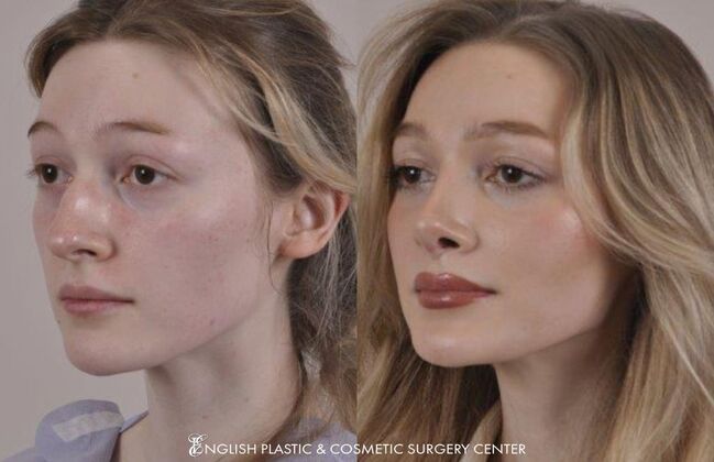 Nose Surgery (Rhinoplasty) Case 5