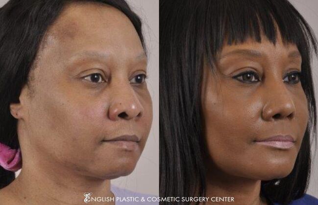 Nose Surgery (Rhinoplasty) Case 8