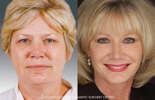 Nose Surgery (Rhinoplasty) Case 7