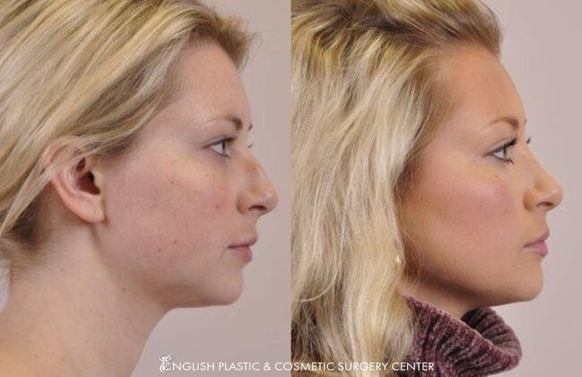 Nose Surgery (Rhinoplasty) Case 4