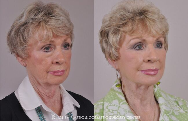 Eyelid Surgery: Case 21 - Before & After